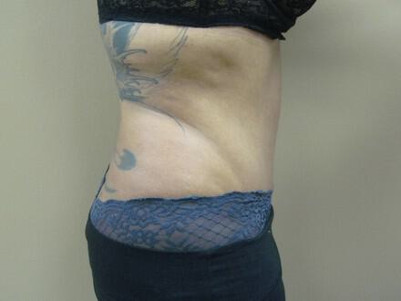 Tummy tuck Before & After Image
