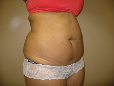 Tummy Tuck Before & After Image