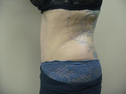 Tummy Tuck Before & After Image