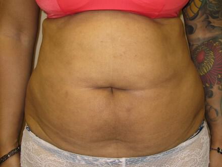 Tummy Tuck Before & After Image