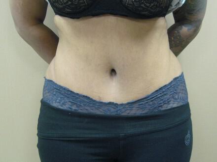 Tummy Tuck Before & After Image