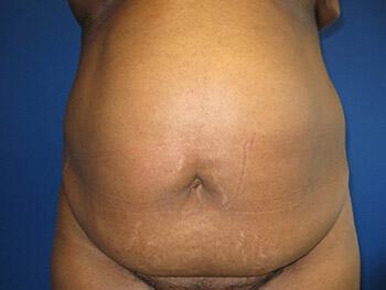 Tummy tuck Before & After Image