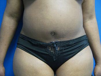 Tummy tuck Before & After Image