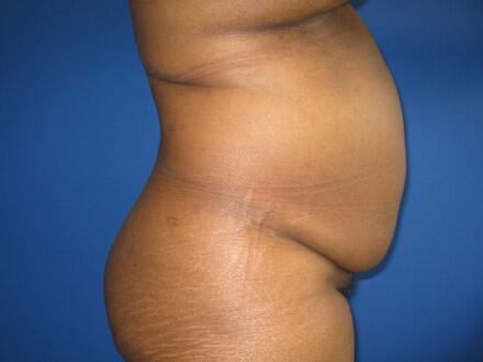 Tummy tuck Before & After Image