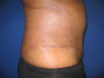 Tummy tuck Before & After Image