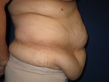 Tummy tuck Before & After Image