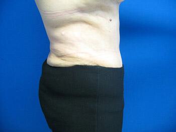 Tummy tuck Before & After Image