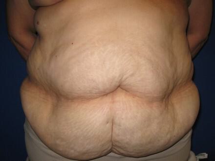 Tummy tuck Before & After Image