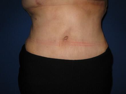 Tummy tuck Before & After Image