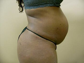 Tummy tuck Before & After Image