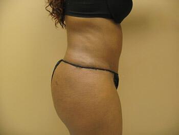 Tummy tuck Before & After Image