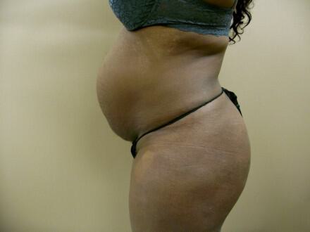 Tummy Tuck Before & After Image