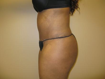 Tummy Tuck Before & After Image