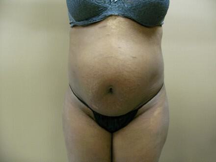Tummy Tuck Before & After Image