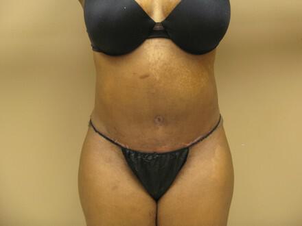 Tummy Tuck Before & After Image