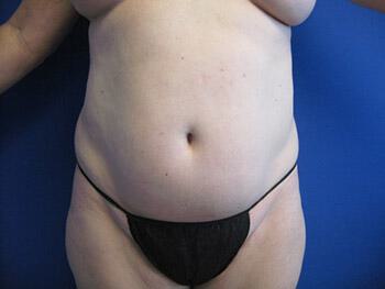 Tummy tuck Before & After Image