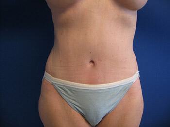 Tummy tuck Before & After Image