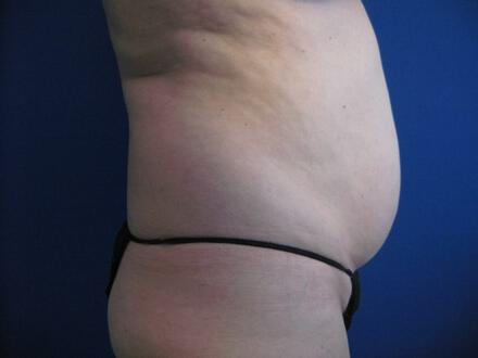 Tummy tuck Before & After Image