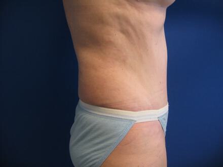 Tummy tuck Before & After Image
