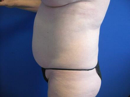 Tummy Tuck Before & After Image