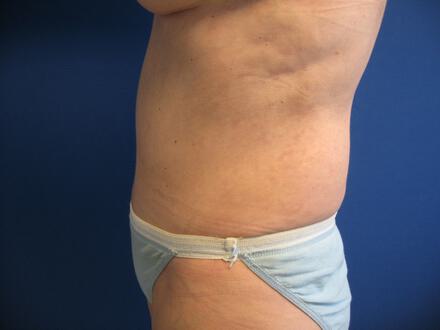 Tummy Tuck Before & After Image