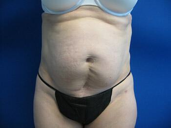 Tummy tuck Before & After Image