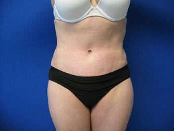 Tummy tuck Before & After Image