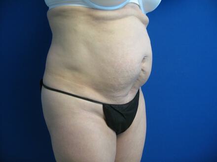 Tummy tuck Before & After Image