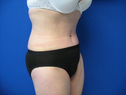Tummy tuck Before & After Image