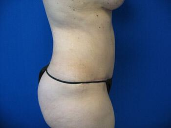 Tummy tuck Before & After Image