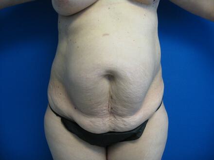 Tummy tuck Before & After Image