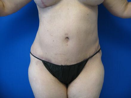 Tummy tuck Before & After Image