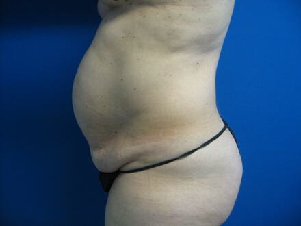 Tummy Tuck Before & After Image