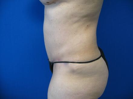 Tummy Tuck Before & After Image