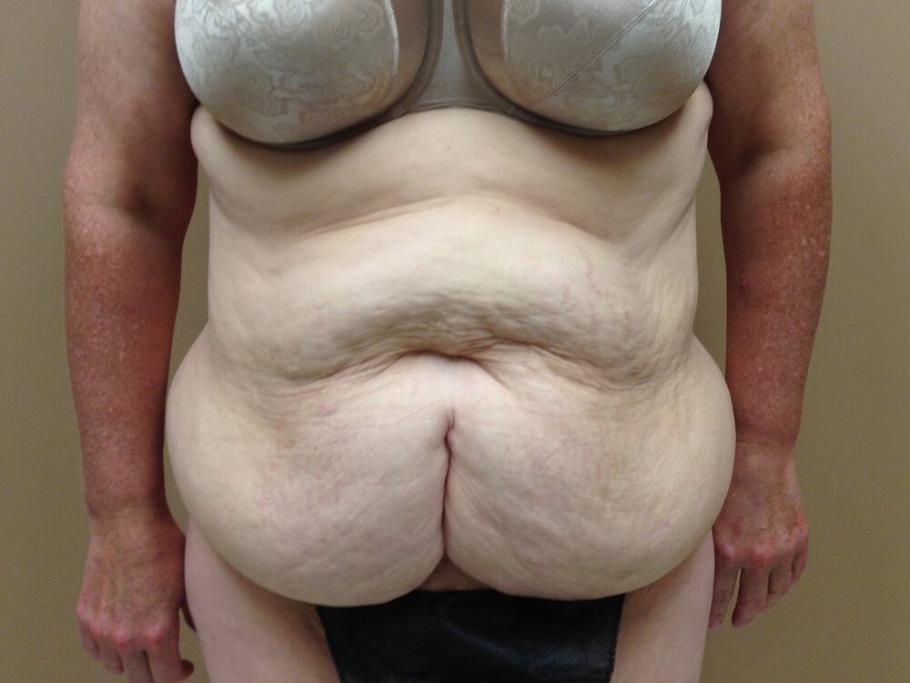 Tummy tuck Before & After Image