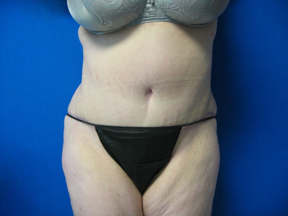 Tummy tuck Before & After Image