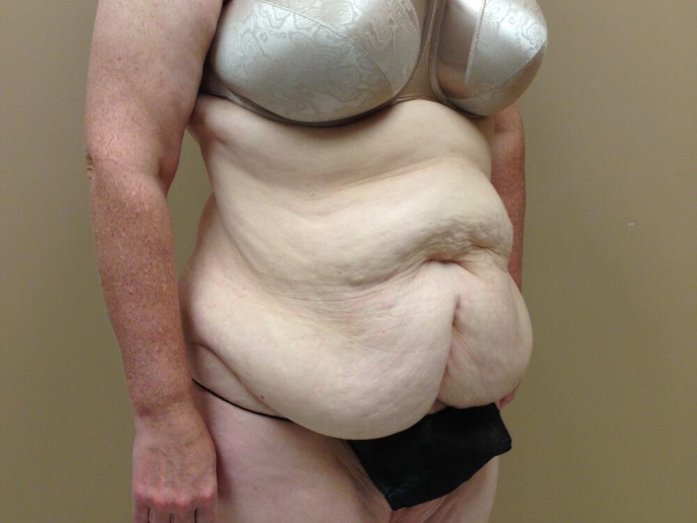 Tummy tuck Before & After Image