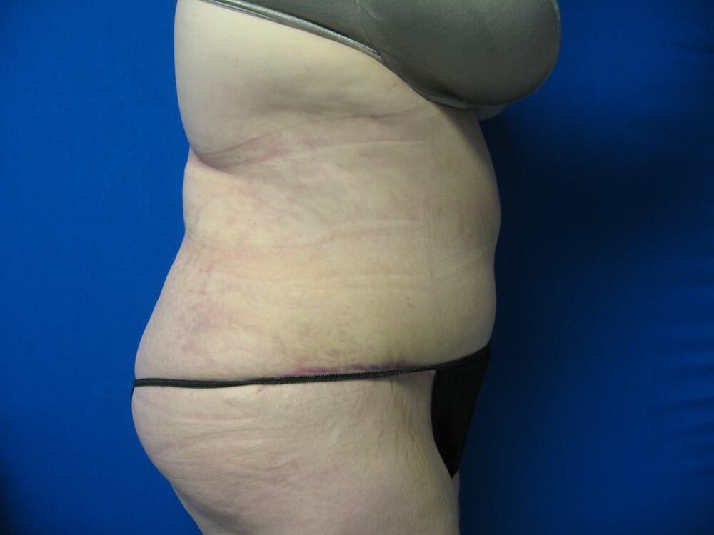 Tummy tuck Before & After Image