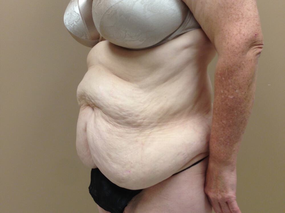 Tummy Tuck Before & After Image