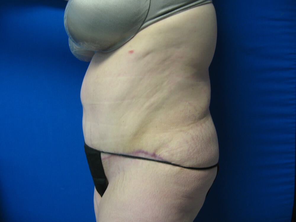 Tummy Tuck Before & After Image