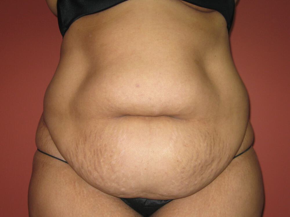 Tummy tuck Before & After Image