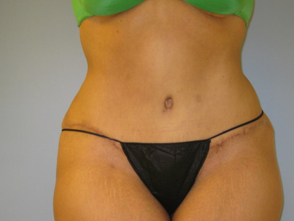 Tummy tuck Before & After Image