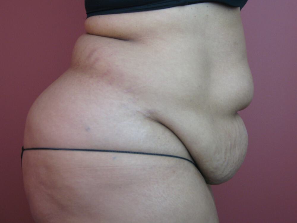 Tummy tuck Before & After Image