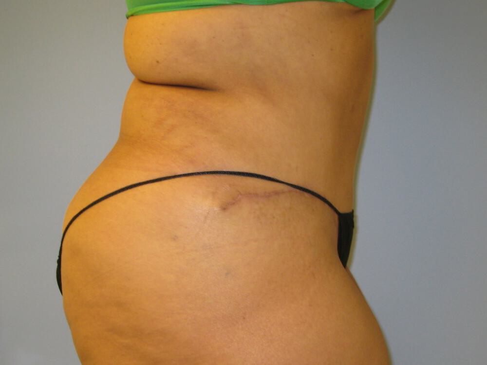 Tummy tuck Before & After Image