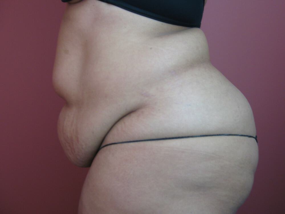 Tummy Tuck Before & After Image
