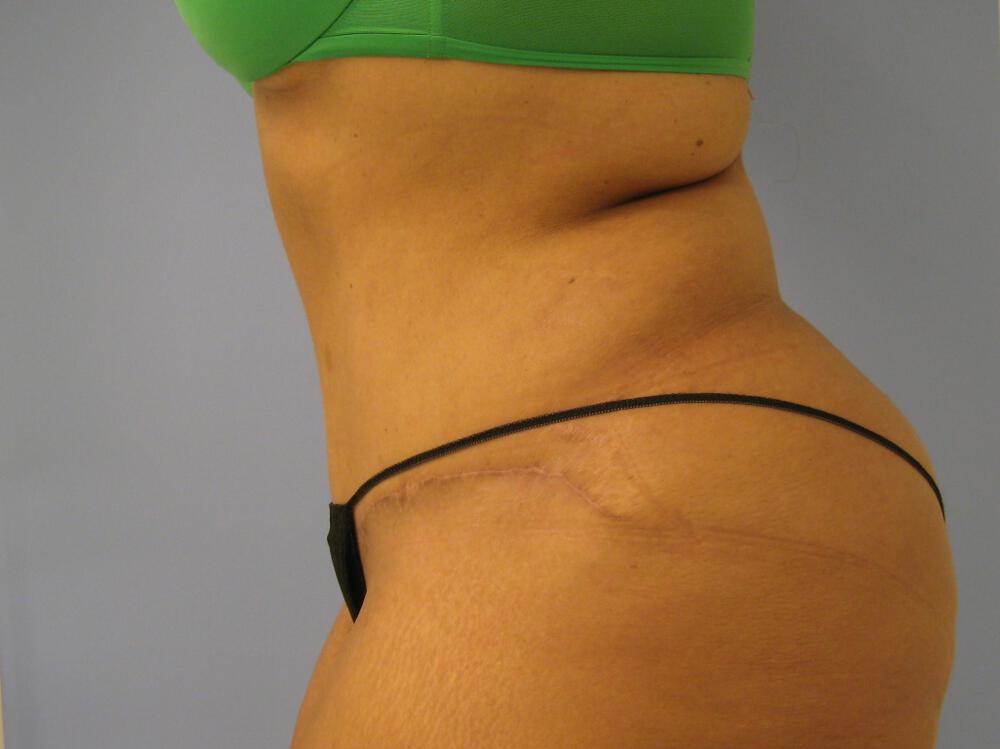 Tummy Tuck Before & After Image