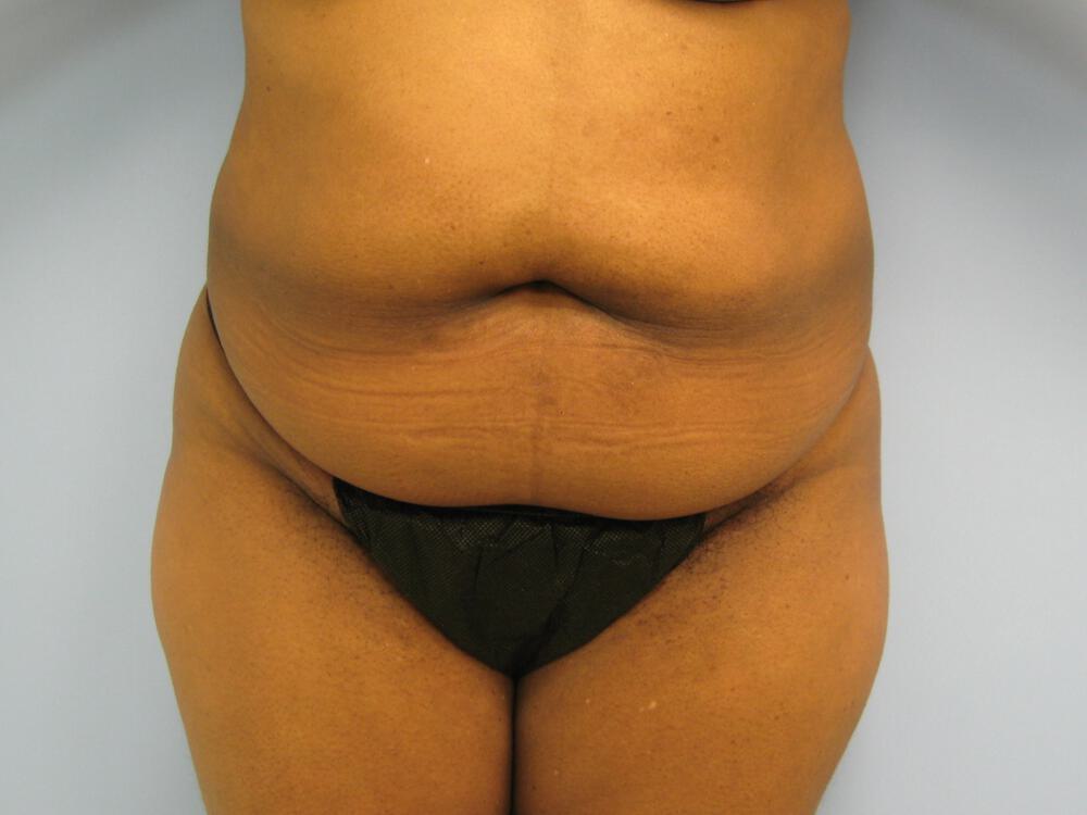 Tummy tuck Before & After Image