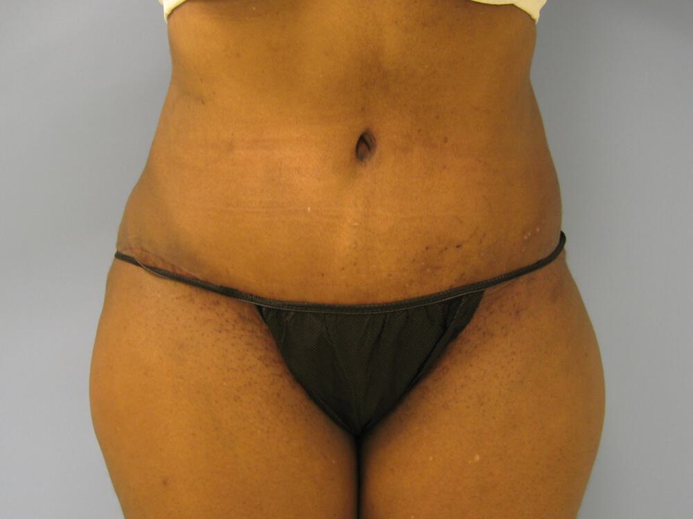 Tummy tuck Before & After Image
