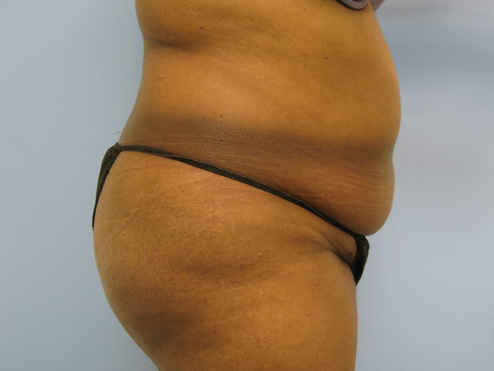 Tummy tuck Before & After Image