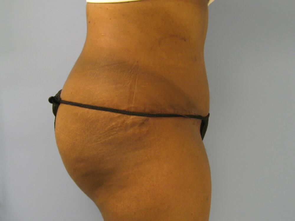 Tummy tuck Before & After Image